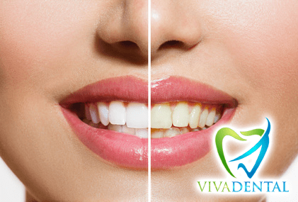 Viva Dental - Bleaching© Subbotina Anna - Fotolia